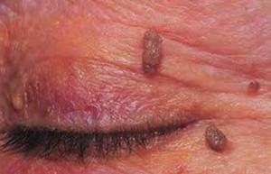Θήλωμα στο βλέφαρο από HPV ιό