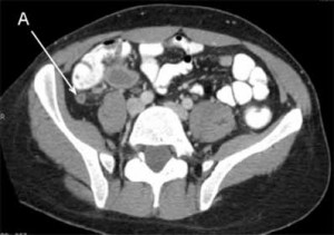 abdo-ct-appendicitis