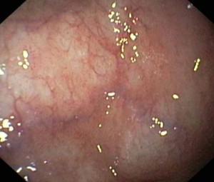 atrophy of the gastric mucosa