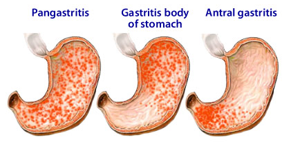 δίαιτα γαστρίτιδα του πυλωρού Η βιοτίνη βοηθά στην απώλεια λίπους στην κοιλιά