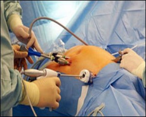 Laparoscopic-Hernia-Surgery