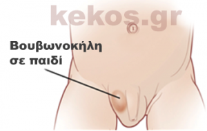 inguinal-hernia_2