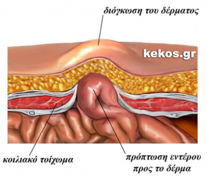 kili56