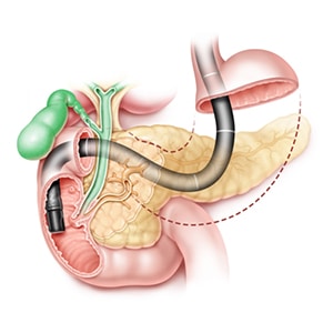 ercp