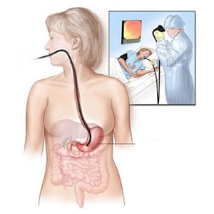 gastroskopisi