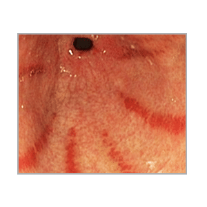 gastririda