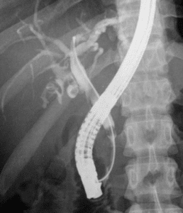 ERCP - Λιθιασική νόσος χοληφόρων