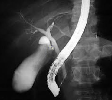 ERCP