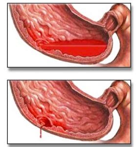 Αίμα στο στομάχι