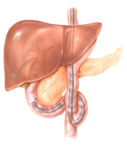 ERCP σε γαστρεκτομή