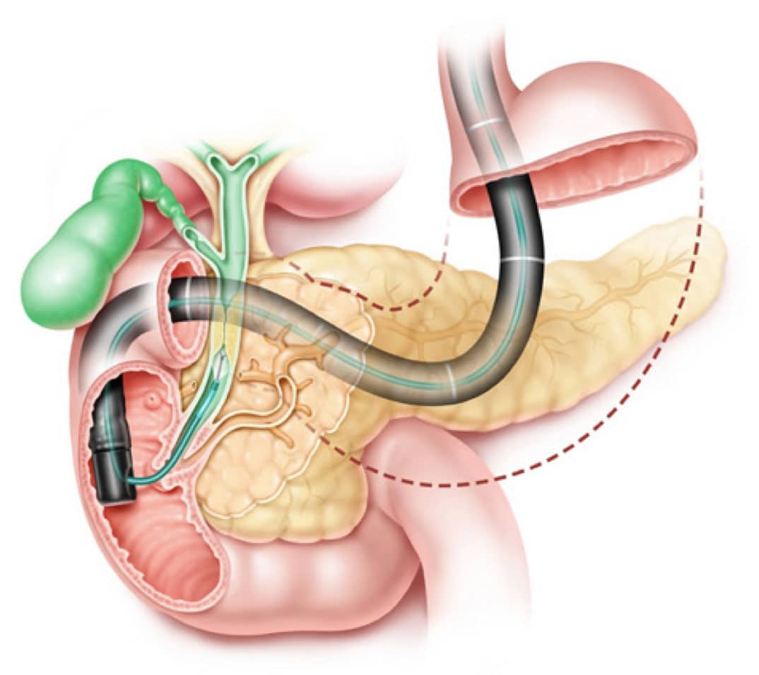Откачать желчь. ЭРХПГ поджелудочной железы. Эндоскопическая ретроградная холангиопанкреатография. Ретроградная холангиопанкреатография ЭРХПГ. Эндоскопическая ретроградная холангиопанкреатография (ЭРХПГ).