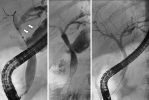 Ενδοσκοπική θεραπεία στένωσης χοληφόρων