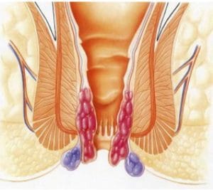 Προσπίπτουσες αιμορροΐδες