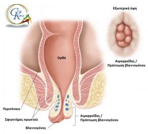 Προσπίπτουσες αιμορροΐδες