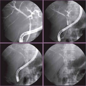 Ενδοσκοπική αντιμετώπιση στένωσης χοληφόρων