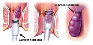 Περίδεση αιμορροΐδων με ελαστικό δακτύλιο