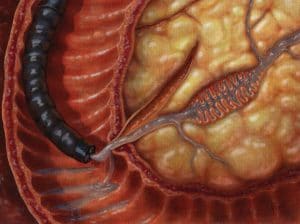 ERCP - Αναρρόφηση παγκρεατικού υγρού για ανάλυση