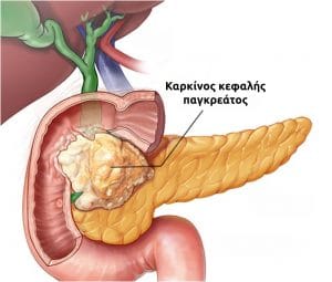 Διήθηση 12δάκτυλου από καρκίνο κεφαλής παγκρέατος