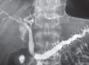 ERCP - Χρόνια παγκρεατίτιδα σε ασθενή με διαχωρισμένο πάγκρεας (divisum)