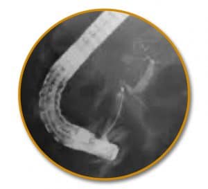ERCP - Διαχωρισμένο πάγκρεας (Divisum) - Κοιλιακή μοίρα
