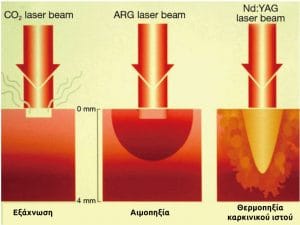 Βιολογικές δράσεις διαφορετικών τύπων Laser