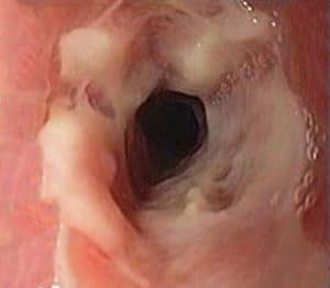 Στένωση οισοφάγου σε νόσο Crohn