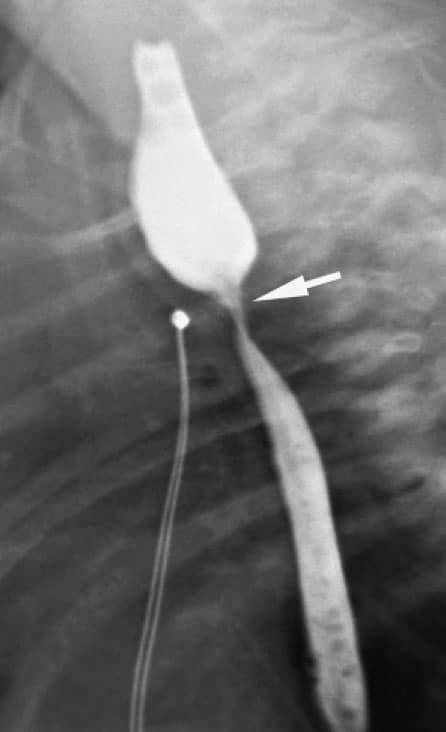 Плохой пищевод. ГЭРБ стриктура пищевода. Стриктура пищевода рентген. Стриктура пищевода КРС. Стеноз пищевода рентген.