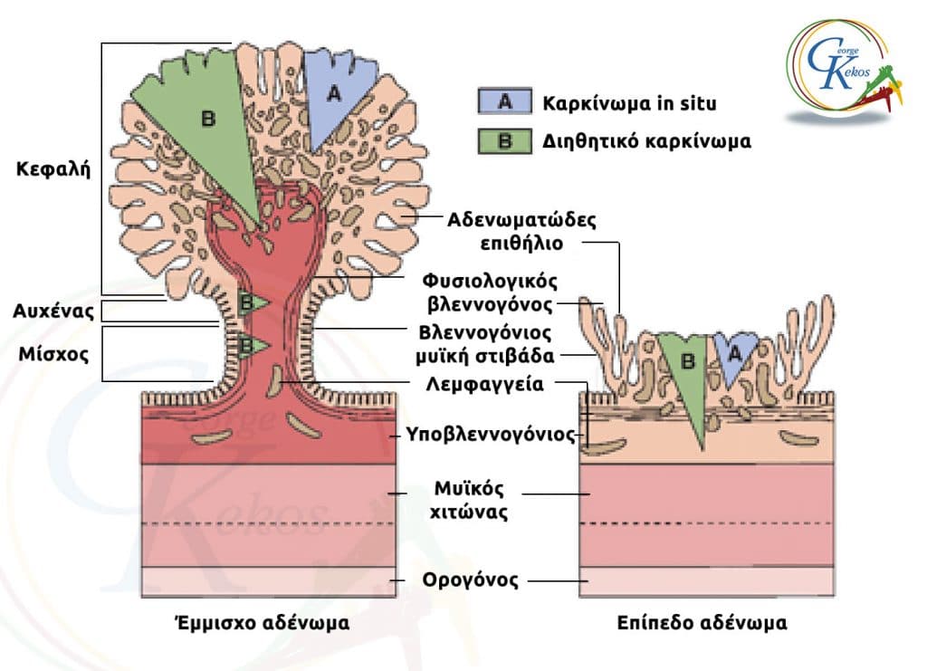Ενδοεπιθηλιακό καρκίνωμα in situ και διηθητικό καρκίνωμα σε έμμισχο και επίπεδο αδένωμα