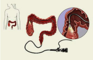 Έλεγχος παχέος εντέρου με κολοσκόπηση